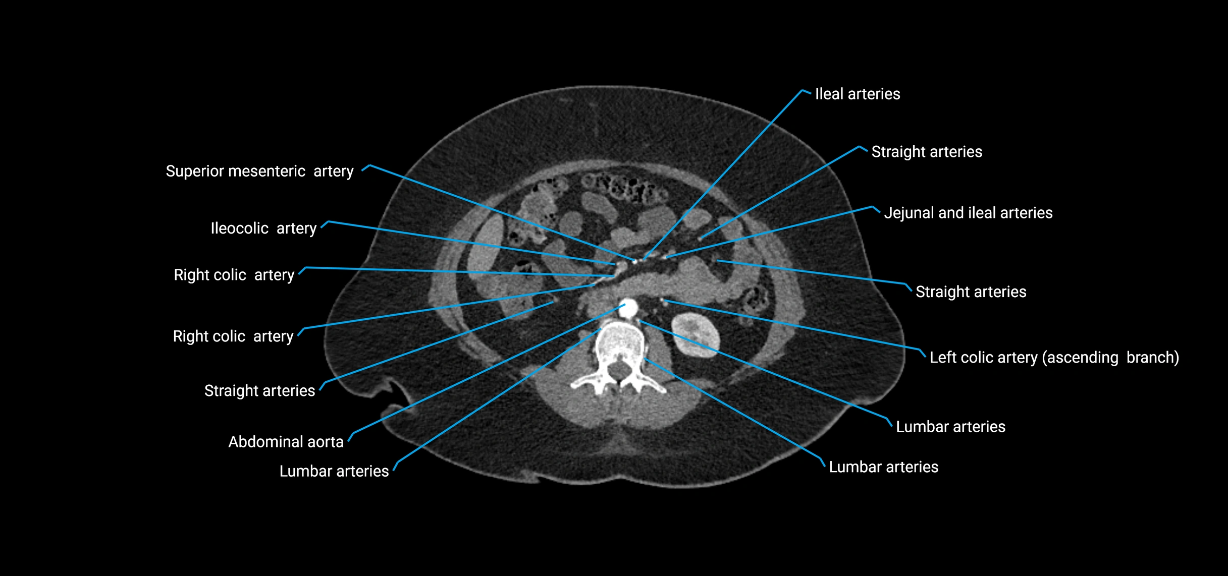 CTA abdomen axial cross sectional anatomy labelled image_96 (2).webp